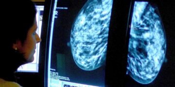 AI-Assisted Mammograms Linked to Reduced Rates of Advanced Breast Cancers