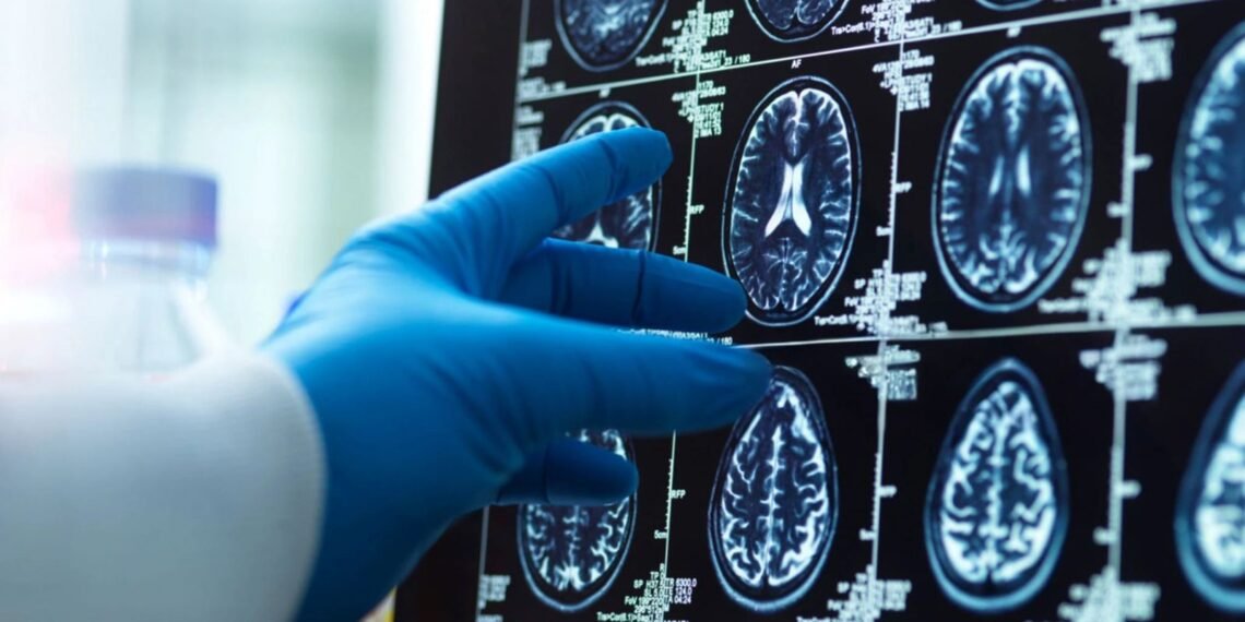 Menopause Linked to Brain Matter Loss, Raising Concerns Over Dementia Risk