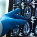 Menopause Linked to Brain Matter Loss, Raising Concerns Over Dementia Risk