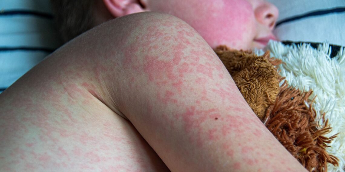 UK Loses Measles Elimination Status, WHO Issues Warning on Vaccine Uptake