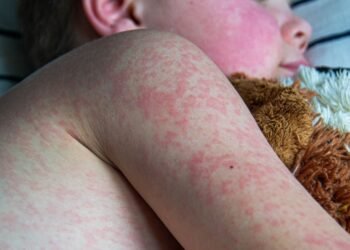 UK Loses Measles Elimination Status, WHO Issues Warning on Vaccine Uptake