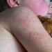 UK Loses Measles Elimination Status, WHO Issues Warning on Vaccine Uptake